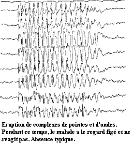 Eruption de complexes de pointes et d'onde.