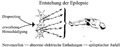 Entstehung der Epilepsie
