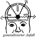 generalisierter Anfall