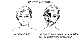 einfacher Herdanfall