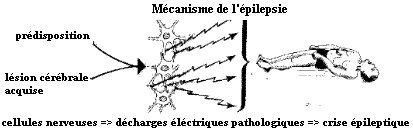 Cause de l'épilepsie