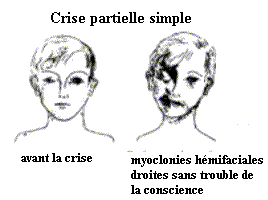 crise partielle simple