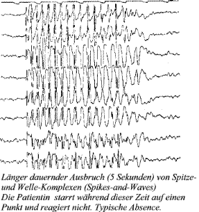 EEG mit Spikes-and-Waves bei Absene